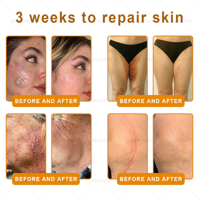 APKAP®Bee venomSkin Restoration Creaml💎💎 Powerful anti-aging solution that targets deepwrinkles,fine lines,sagging skin,and dryness