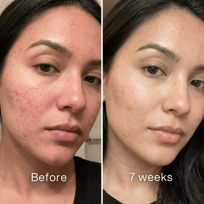 ✨ LAST DAY BUY 1 GET 1 FREE✨Cheapsu™ Clinical Acne Scar Remodeling Stick