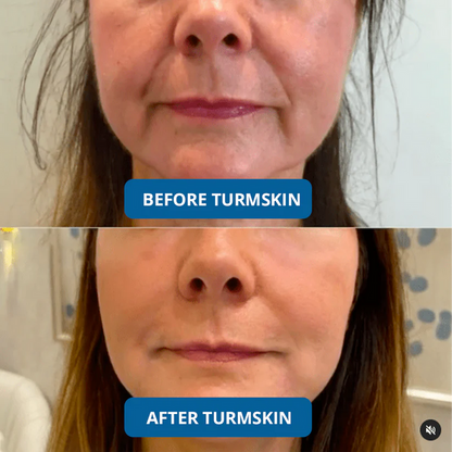 Luxevéria : Clinical-Grade Collagen That Erases Deep Lines Without Needles