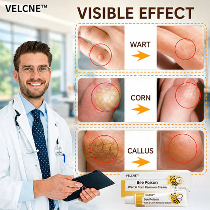 👩‍⚕️Velcne™Bee Poison Wart & Corn Remover Cream