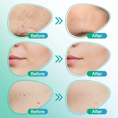 ✨ LAST DAY BUY 1 GET 1 FREE✨𝗖𝗮𝗿𝗲𝗕𝗿𝗲𝗲𝘇𝗲® 3-in-1 Microneedle Care Patch