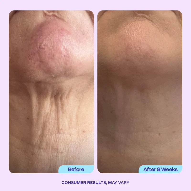 Miracle Neck Cream for "Tech Neck" & "Turkey Neck", Visibly Firmer, Smoother-Looking Skin in 4–8 Weeks