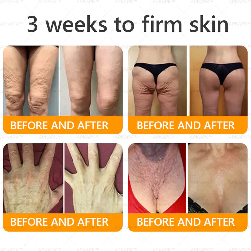 APKAP®Bee venomSkin Restoration Creaml💎💎 Powerful anti-aging solution that targets deepwrinkles,fine lines,sagging skin,and dryness