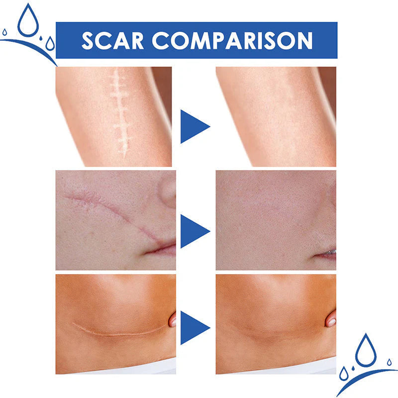 ✨ LAST DAY BUY 1 GET 1 FREE✨Scar Repair Cream for Men and Women, fade scars and tighten skin in one step
